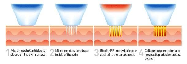 Sanhe FRACTIONAL RF MICRONEEDLE (FRM)