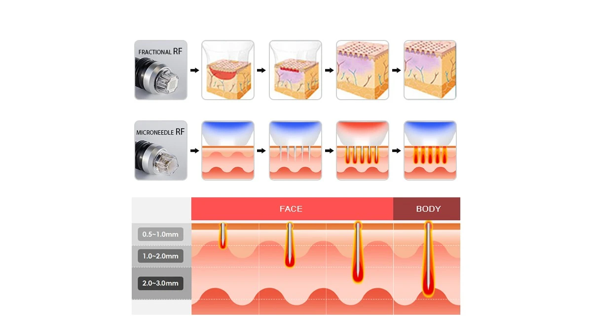 Mrico Needle Fractional RF Machine